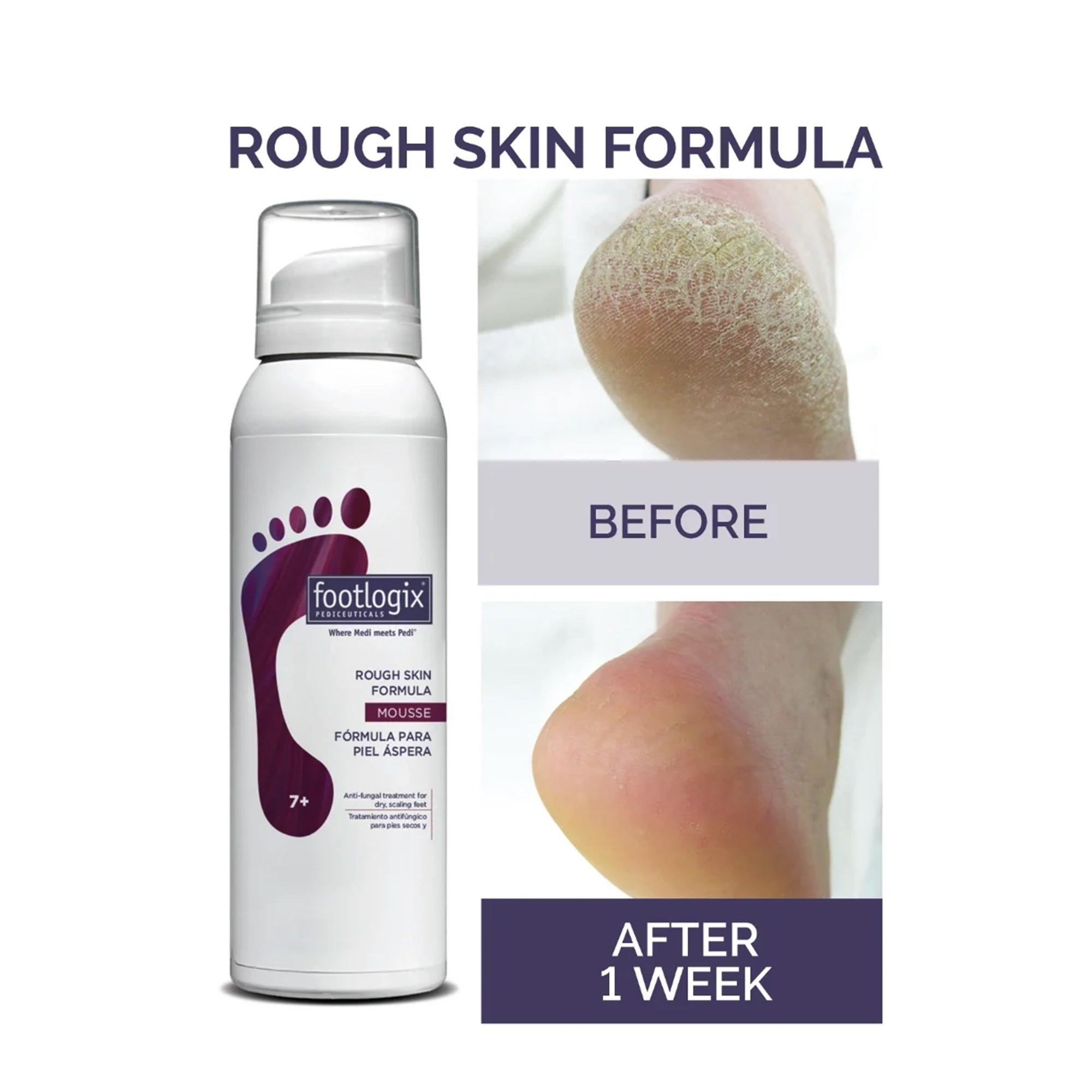 Rough Skin Formula