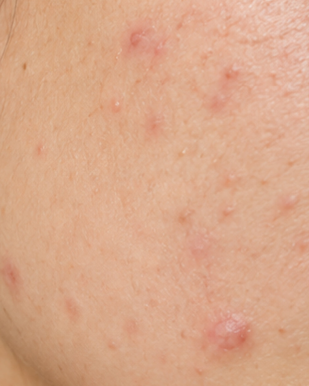 Acne & Blemishes