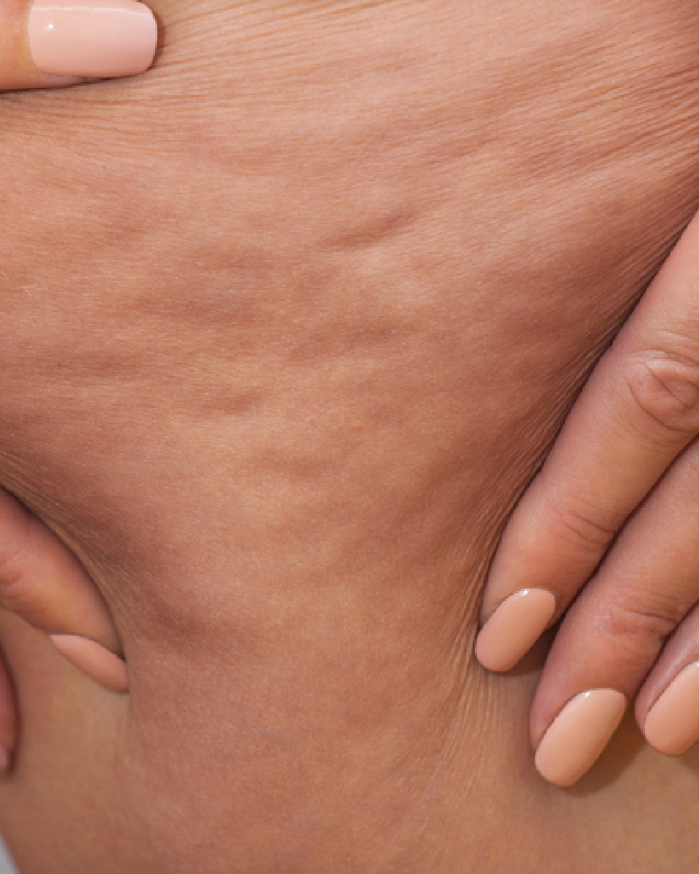 Cellulite