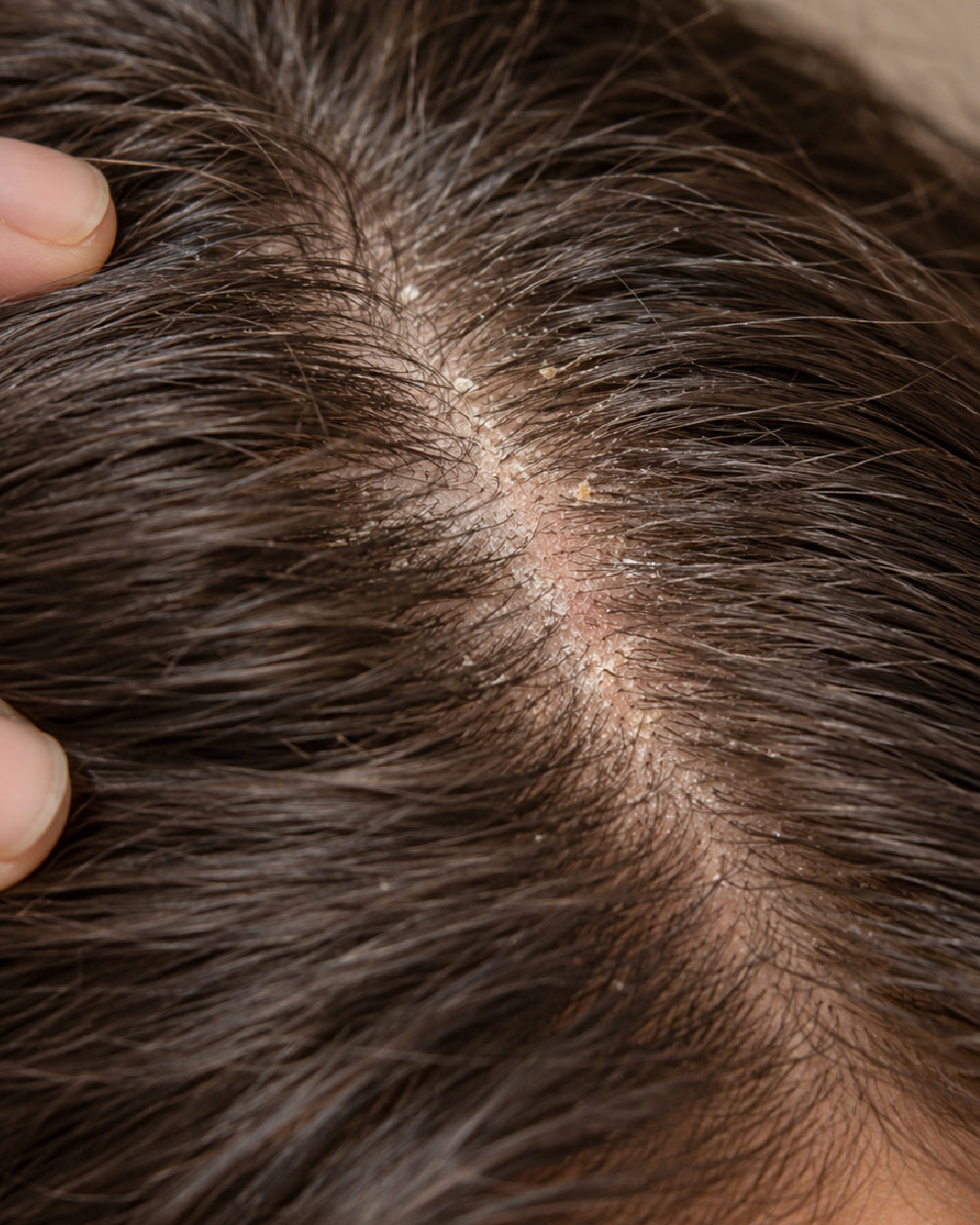 Dry Scalp