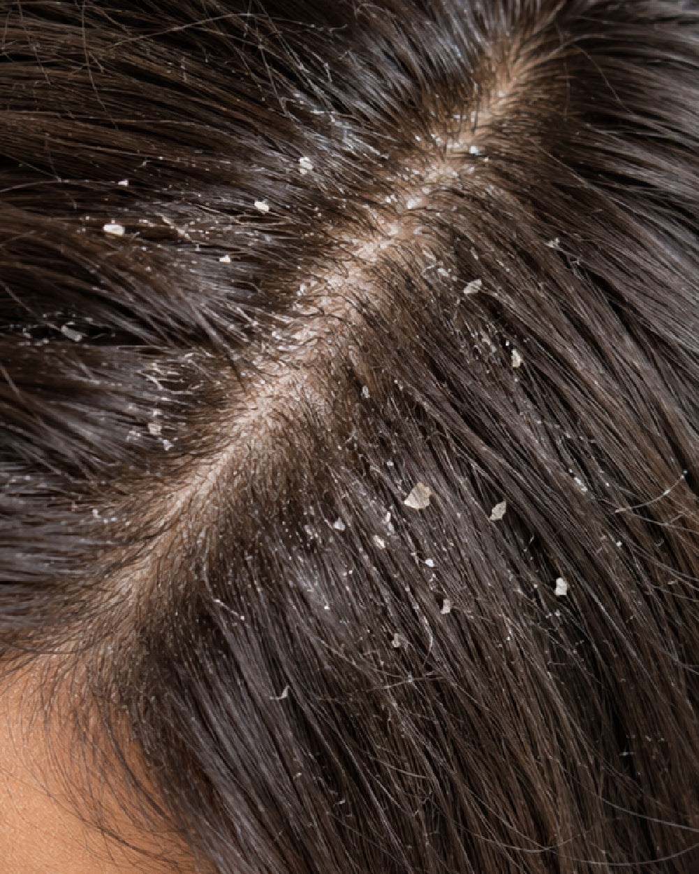 Hair Dandruff