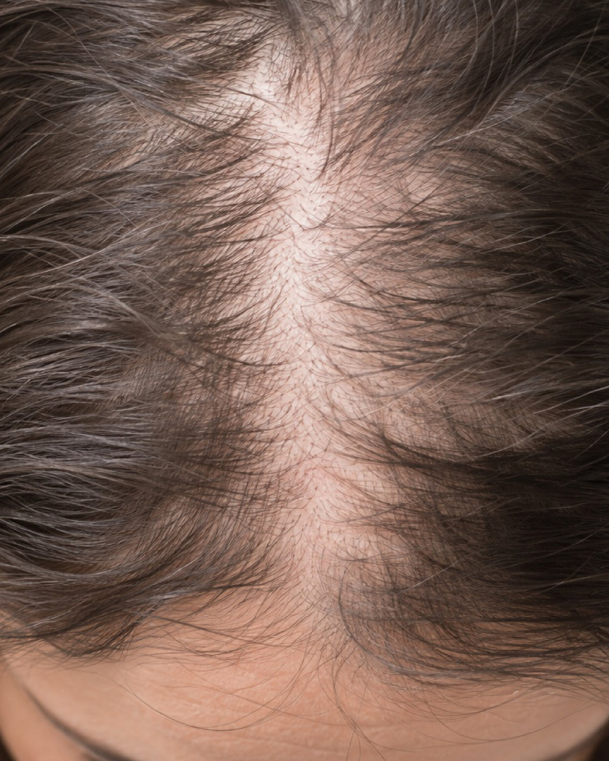 Hair Loss