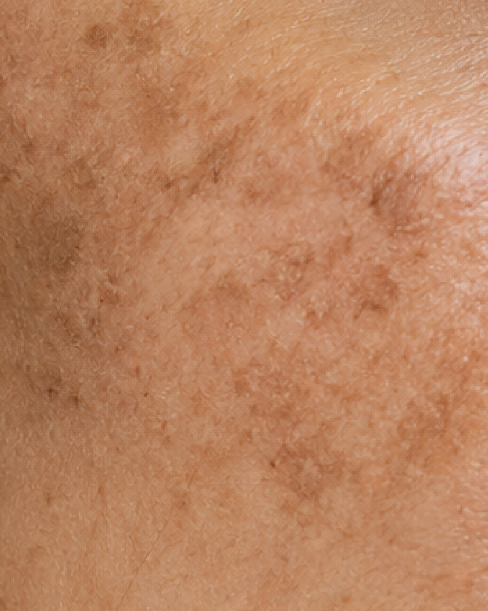 Pigmentation