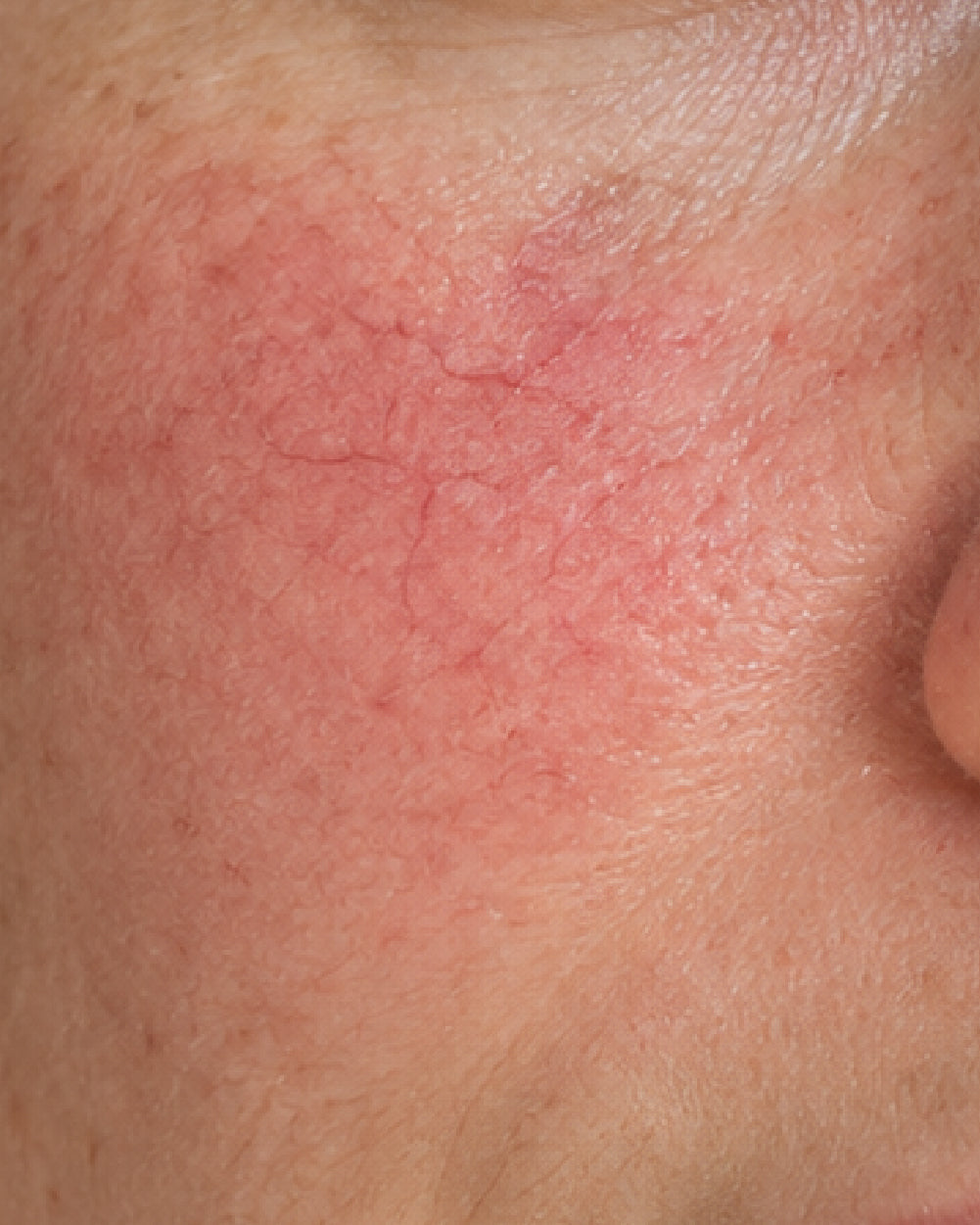 Skin Redness